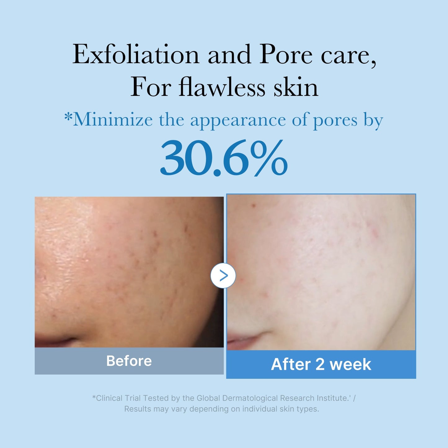 Zero Pore Ampoule